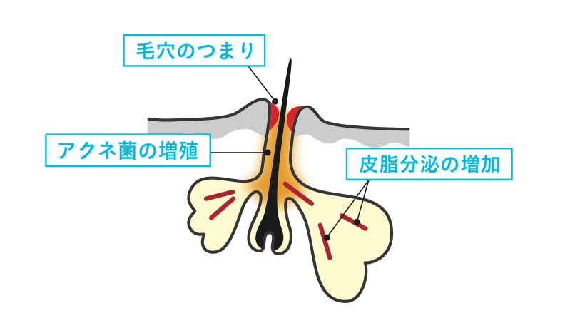 ニキビができる要因