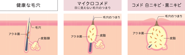 ニキビの種類1