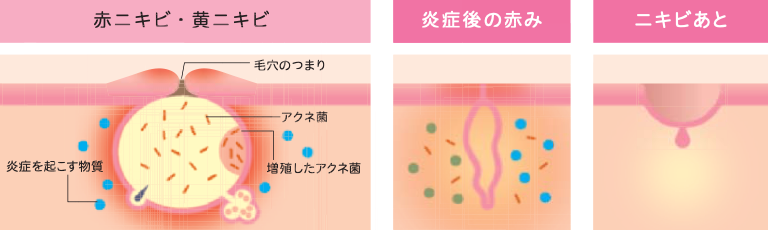 ニキビの種類2