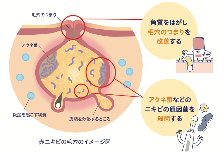 過酸化ベンゾイル製剤