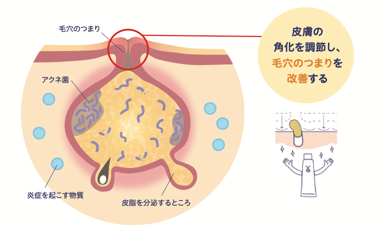 アダパレン製剤