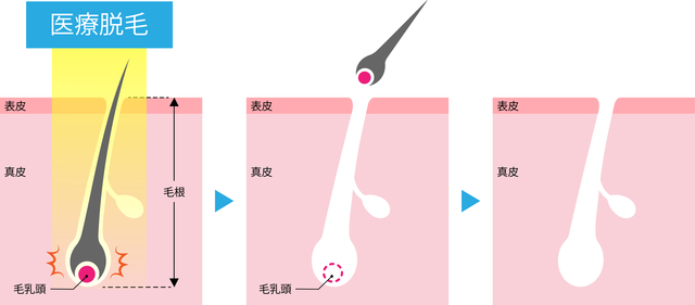 医療脱毛